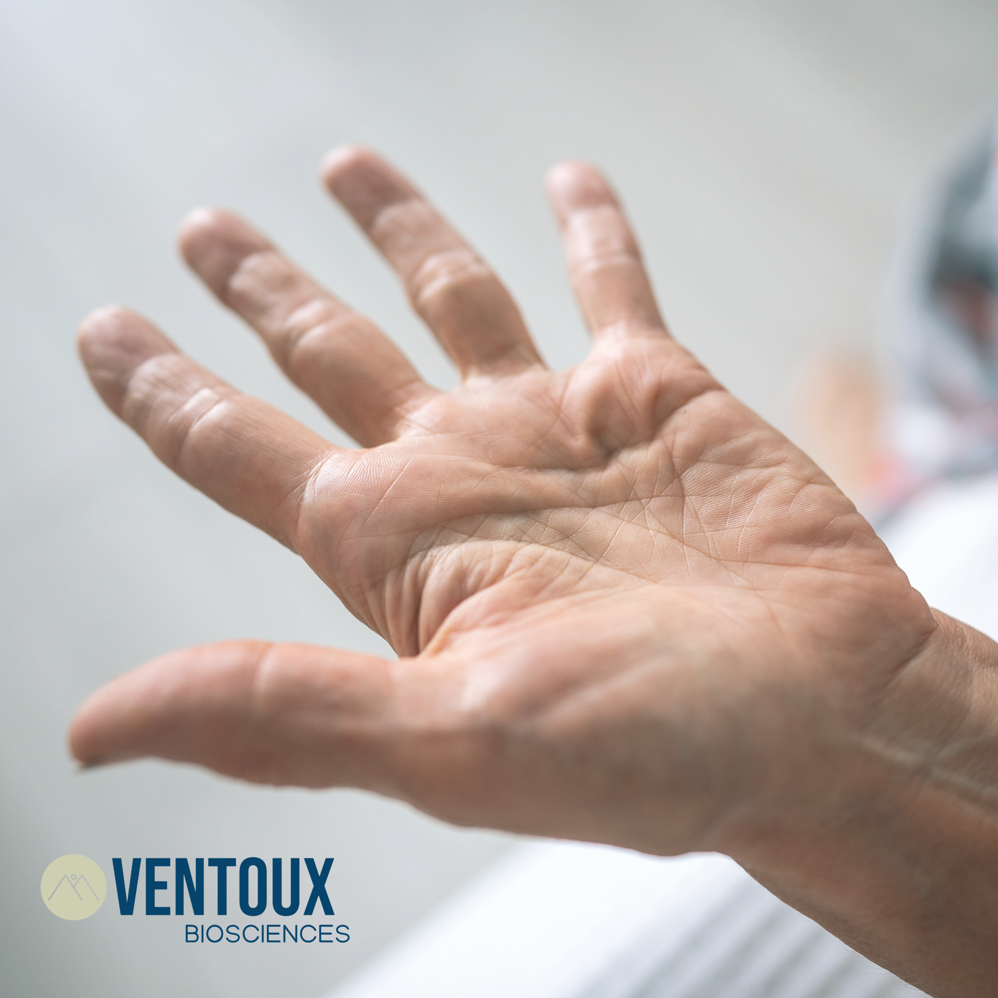 Early stage Dupuytren's disease - an immune-fibrotic disease of the hands